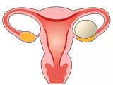 卵巢囊肿——助孕路上的拦路虎
