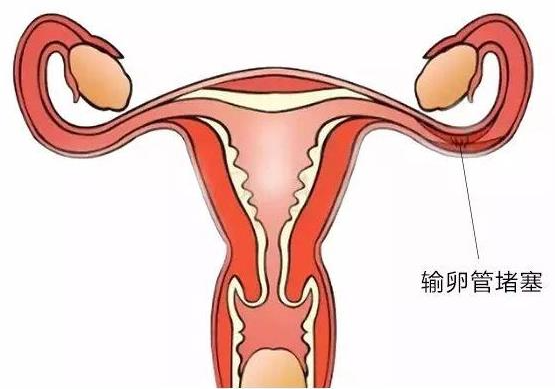 输卵管阻碍是唯一不痛不痒的病，你了解它吗?