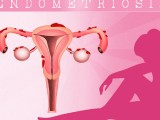 女性卵巢囊肿导致不能怀孕的原因